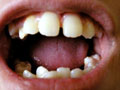 Hoitotakuu hampaaton suun terveydenhuollossa