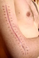 Tarkennuksia tilapäisen ja pysyvän kosmeettisen haitan vammakohtaisiin luokitteluihin 1.1.2012 alkaen